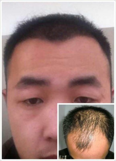 专业植发